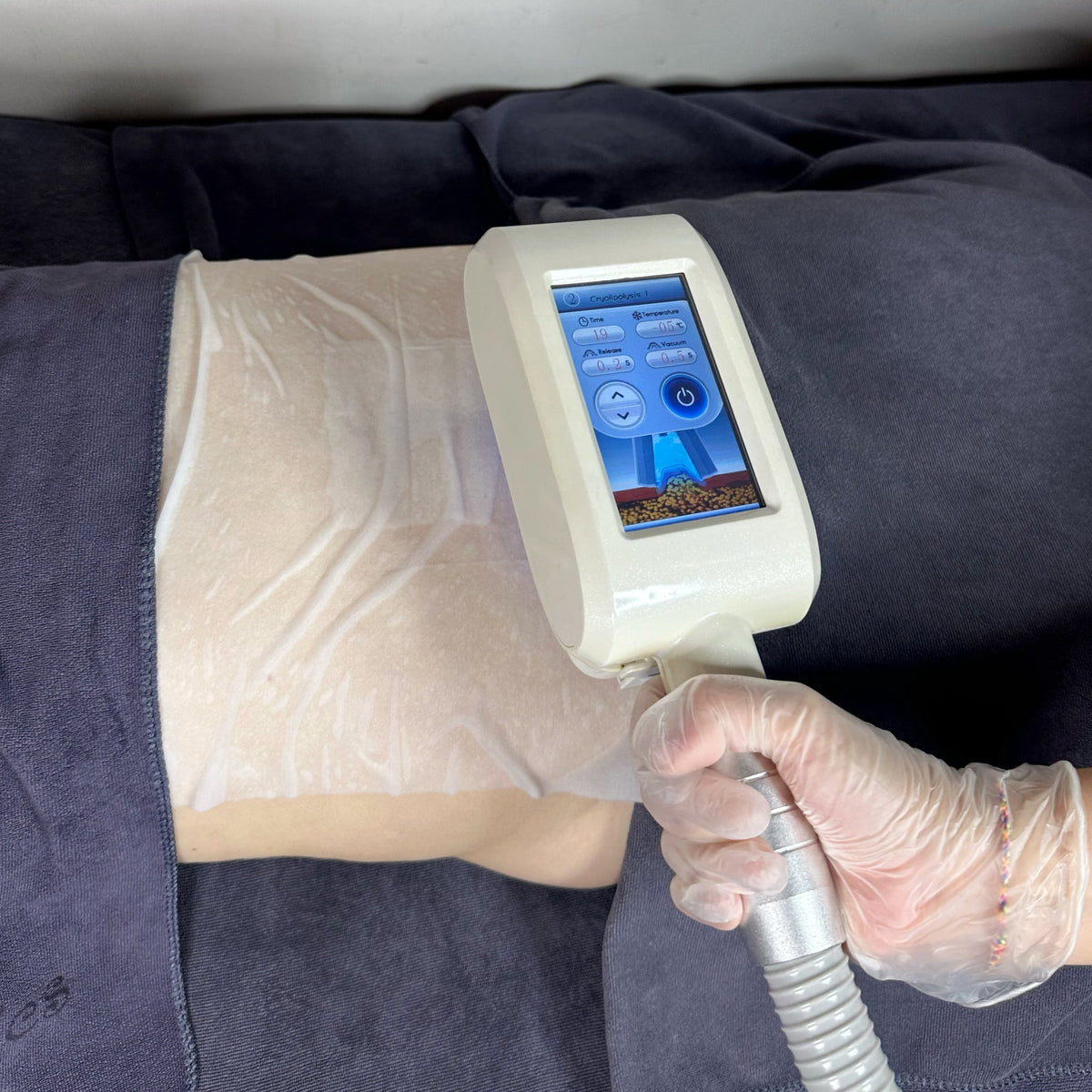360° Fat Freeze 1st Trial